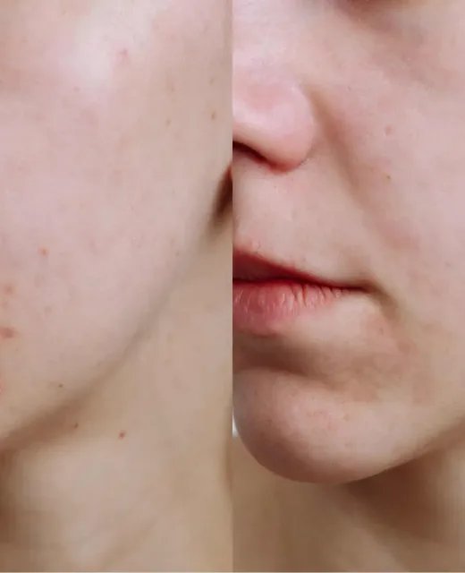 Acne Foto