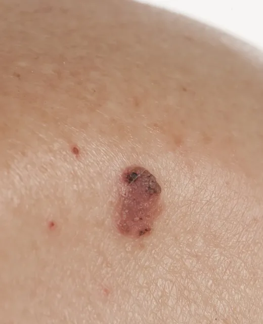 Keratinizing,Squamous,Cell,Carcinoma,Of,The,Skin,On,The,Back