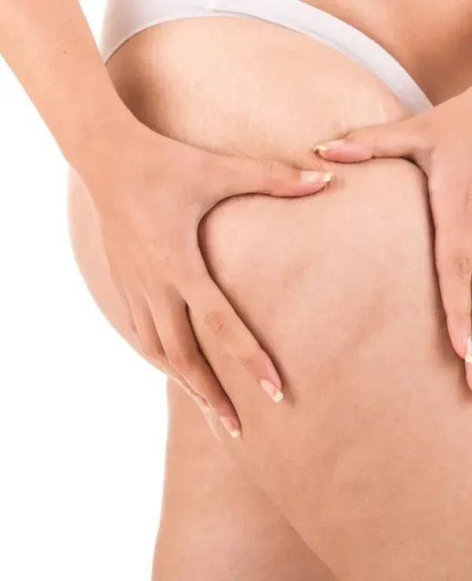 Celulite e Gordura Localizada​
