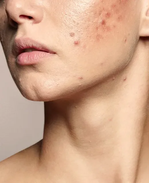 Cicatriz de Acne 2