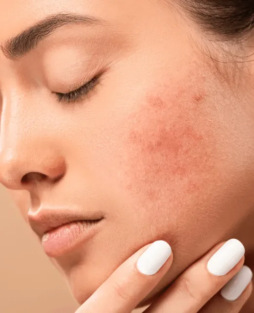 Cicatriz de Acne