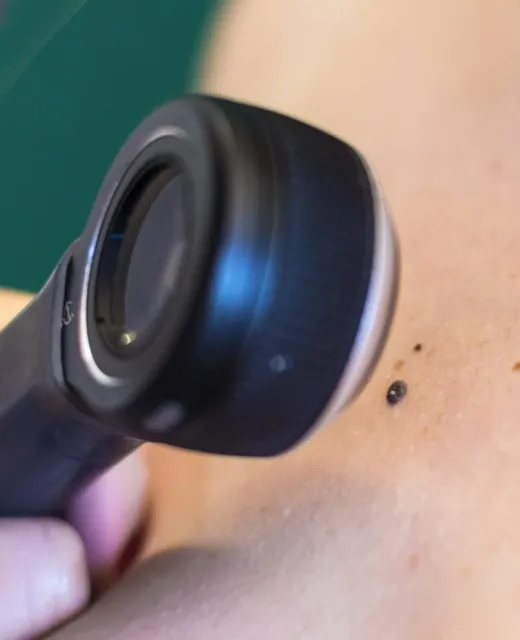 Dermatoscopia