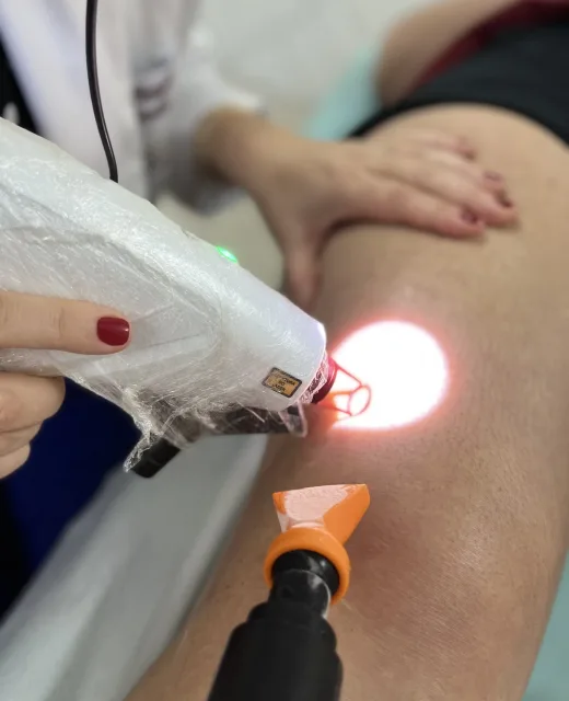 Laser para Tratamento de Vasos