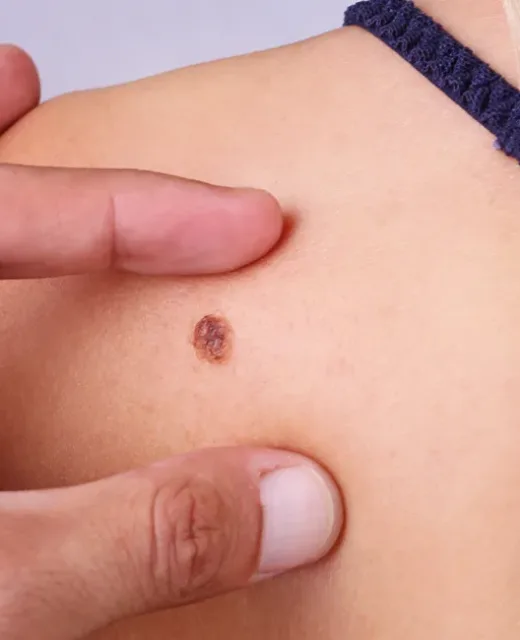 Melanoma