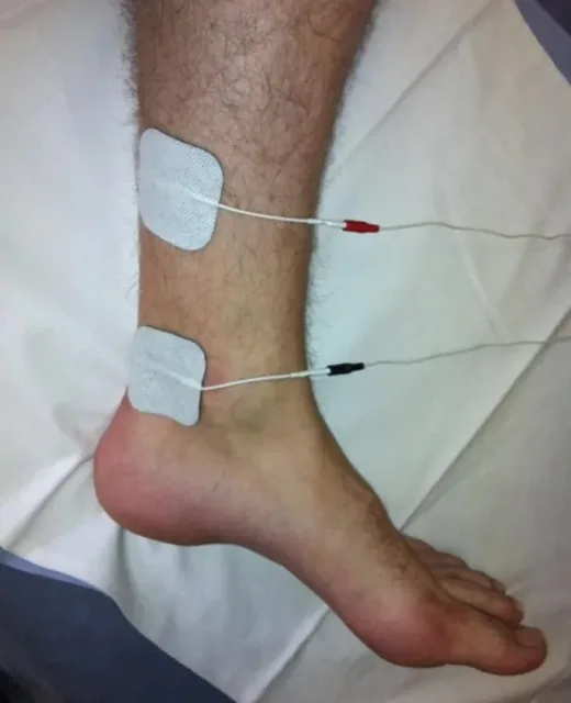 Neuroestimulação Tibial Posterior 2
