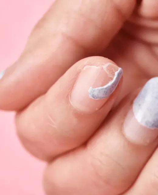 Síndrome das Unhas Frágeis 2