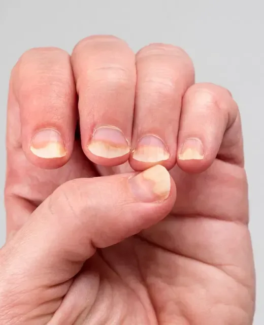Síndrome das Unhas Frágeis